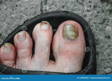 Toenails Affected By An Infectious Diseasefungal Infection Of The Nail