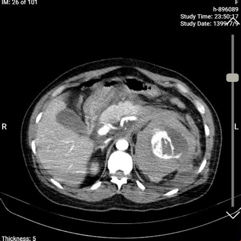 Ct Scan Showing Hemorrhagic Renal Cysts In The Left Kidney Note Ct