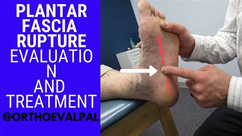 Plantar Fascia Rupture Evaluation With Paul Marquis Pt Youtube