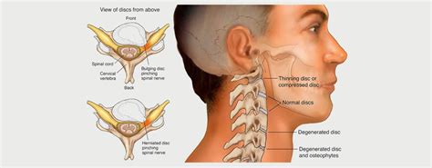 CERVICAL HERNIATED DISC MOTUS Physical Therapy