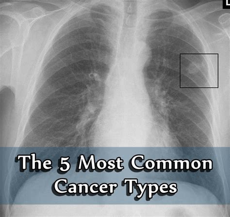 Most Common Types Of Lung Cancer Cancerwalls