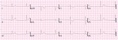 Dr Smiths Ecg Blog What Is The Culprit Artery Not What You Think