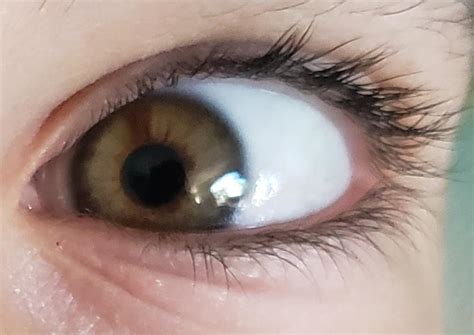 Sectoral Heterochromia Reyes