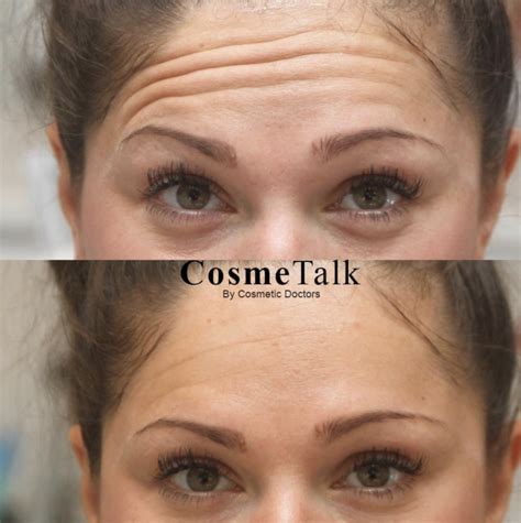 Botox Eyebrow Lift Before After Photos Eyebrowshaper