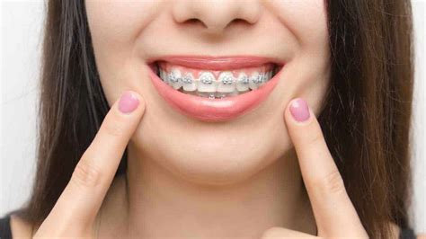 What Are Ceramic Braces Ceramic Braces Vs Metal Braces Western