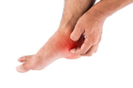 Athlete's Foot Fungus | Syracuse Podiatry - Dr. Ryan D'Amico