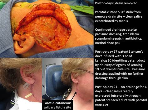 Complication From Open Parotid Ductoplasty For Stone With Parotid