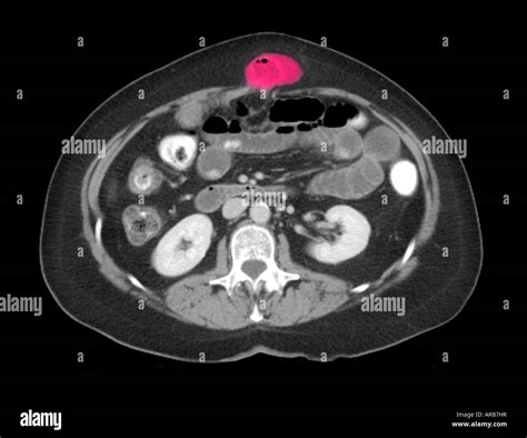 Ct Scan Axial View Showing An Abdominal Wall Hernia Stock Photo