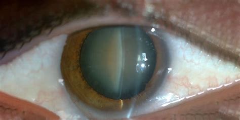 Post Cataract Surgery A Post Operative Care Guide