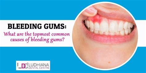 Bleeding Gums What Are The Topmost Common Causes Of Bleeding Gums