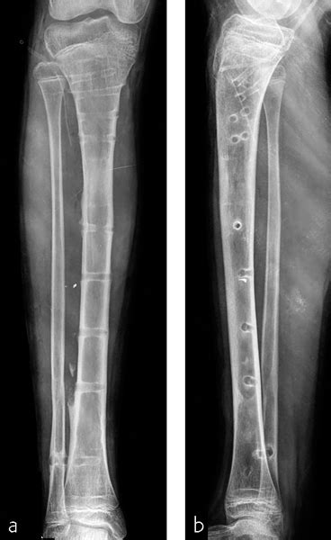 Minimally Invasive Plate Osteosynthesis And Limb Lengthening
