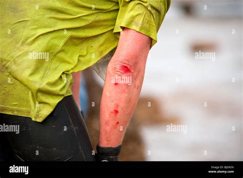 Cut And Bleeding Arm Stock Photo Alamy