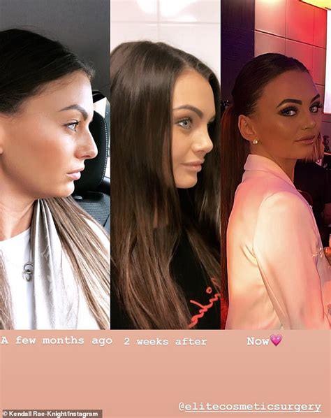 Love Island S Kendall Rae Knight Shows Off The Results Of Her Secret Nose Job Heading To The