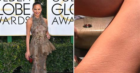 Chrissy Teigen Tweets Close Up Photo Of Her Stretch Marks