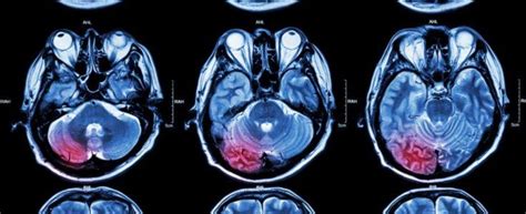 Primary Brain Tumor Types What To Know And Faqs