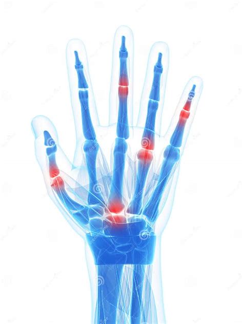 Highlighted Arthritic Hand Stock Illustration Illustration Of Human