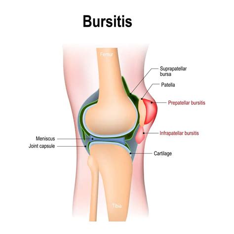 Complete Guide To Bursitis Torrance Sports Medicine Doctor