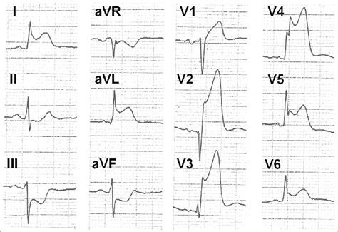 Ecg Shows Anterior St Elevation Myocardial Infarction Of The Left
