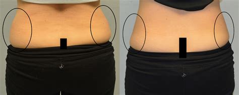 Coolsculpting Before And After Picture Female Love Handles