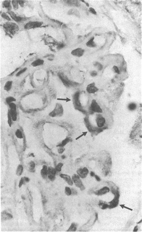 Sle Patient 5 Membranous Lupus Glomerulonephritis Staining With