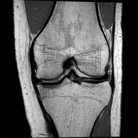 It is constructed by 4 bones and an extensive network of ligaments and muscles.1. Normal knee MRI | Image | Radiopaedia.org
