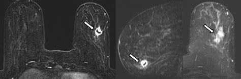 Breast Mri False Negative Results And Missed Opportunities Radiographics