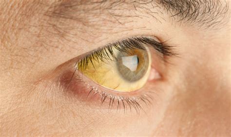 High Blood Pressure Symptoms Blood Spots In Your Eyes Could Be A Tell