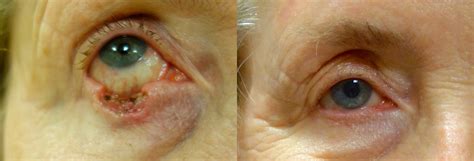 Eyelid Skin Cancer Mohs Reconstruction Before And After Photos