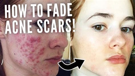 How To Fade Acne Scars Youtube