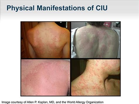 Chronic Idiopathic Urticaria A Primer On Identification And Treatment Transcript