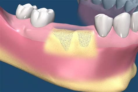 Bone Grafting Procedures Methuen Periodontics And Implant Dentistry