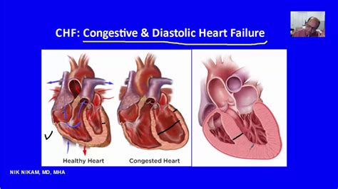 Diastolic Congestive Heart Failure