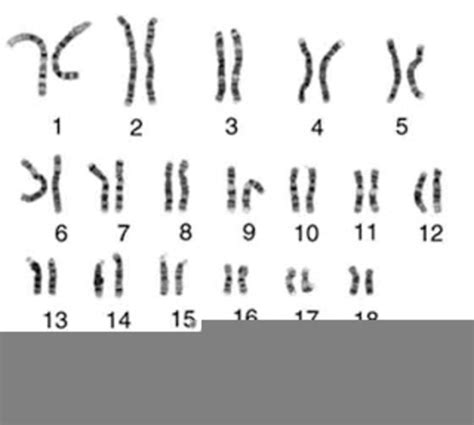 Wilsons Disease Karyotype Free Images At Clker Vector Clip Art