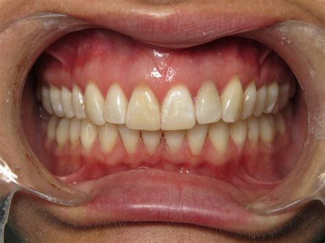 Invisalign & Bonding - A Cosmetic Dentistry Technique: Dr. Joe N.T. Nguyen