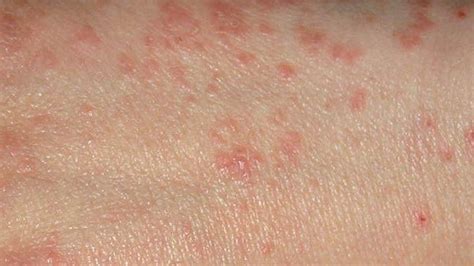 How To Get Rid Of Scabies While Travelling Ready For Road