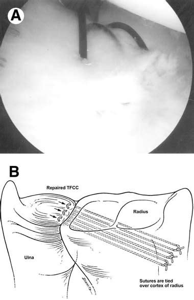 Arthroscopic Repair Of Radial Sided Triangular Fibrocartilage Complex