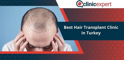 Best Hair Transplant Clinic In Turkey Clinicexpert