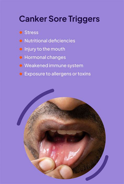 Canker Sore Symptoms And Treatments