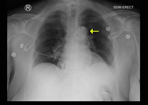 Cureus Unidentified Object In The Mediastinum A Case Report Of