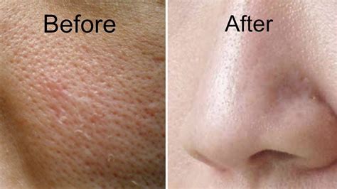 Large Pores Treatment Dubai And Abu Dhabi Skin Care Clinic