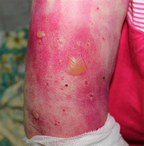 An 80 Year Old Woman With An Itchy Blistering Rash Medical Exam Prep