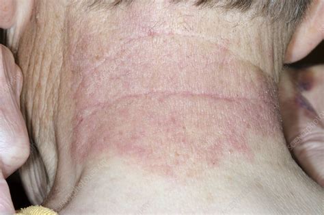 Contact Dermatitis On The Neck Stock Image C0168181 Science