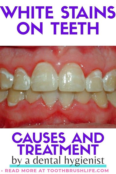 White Spots On Teeth Causes And How To Get Rid Of Them Toothbrush