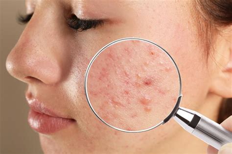 Common Types Of Acne And How To Treat Them Rapaport Dermatology Of Beverly Hills Dermatologists