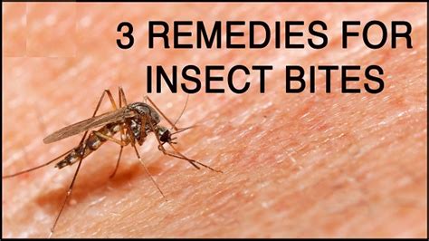 20 Best Home Remedies For Mosquito Bites To Get Rid Of Irritation
