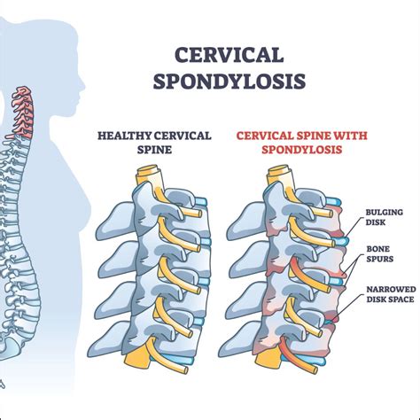 Cervical Spondylosis Causes Risk Factors Symptoms Treatment
