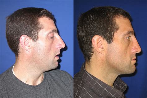 Nose Surgery Before And After Photos Patient 35 San Francisco Ca