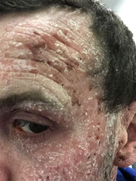 Man Who Struggled With Eczema On His Face For Years Is Treating The