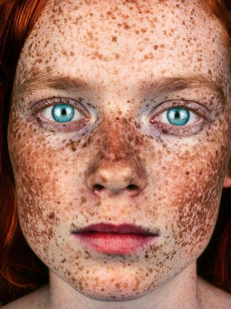 Exploring The Phenomenon Of Shiny Freckles Causes Diagnosis And