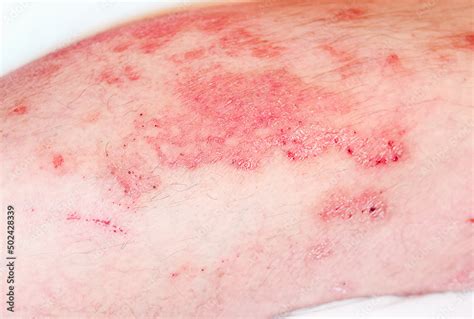Acute Psoriasis Severe Reddening Of The Skinan Autoimmuneincurable